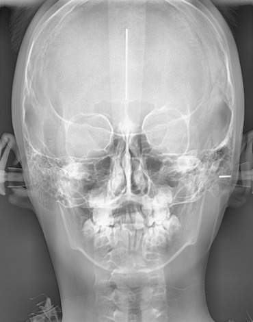 위턱뼈확장장치(RPE)를 장착하고 한달만에 위턱뼈가 양 옆으로 벌어진 모습 - Initial