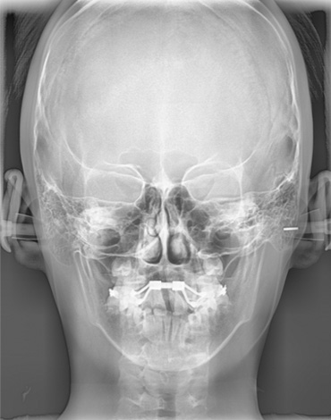 위턱뼈확장장치(RPE)를 장착하고 한달만에 위턱뼈가 양 옆으로 벌어진 모습 - RPE 1M