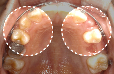 좁은 위턱뼈를 입천장확장장치 (RPE)를 통해 확장하여 송곳니 맹출 공간을 확보한 사진