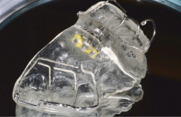 좁은 위턱뼈를 입천장확장장치 (RPE)를 통해 확장하여 송곳니 맹출 공간을 확보한 사진