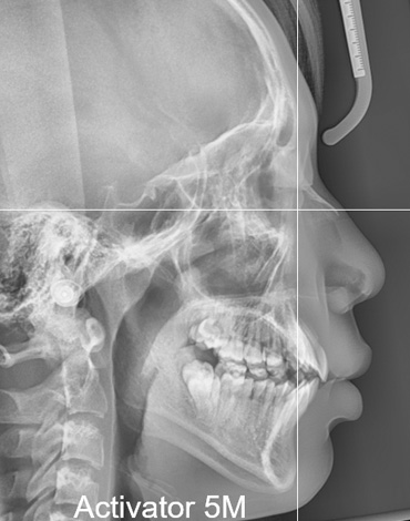 무턱 성장교정치료 5개월만에 아래턱 뼈의 성장 발육 및 위치변화