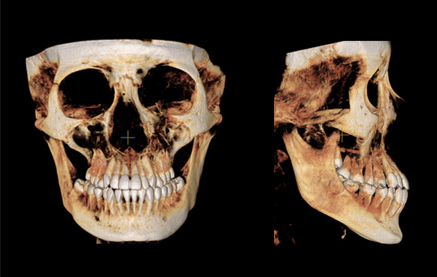 초정밀 턱관절 CT 형태분석